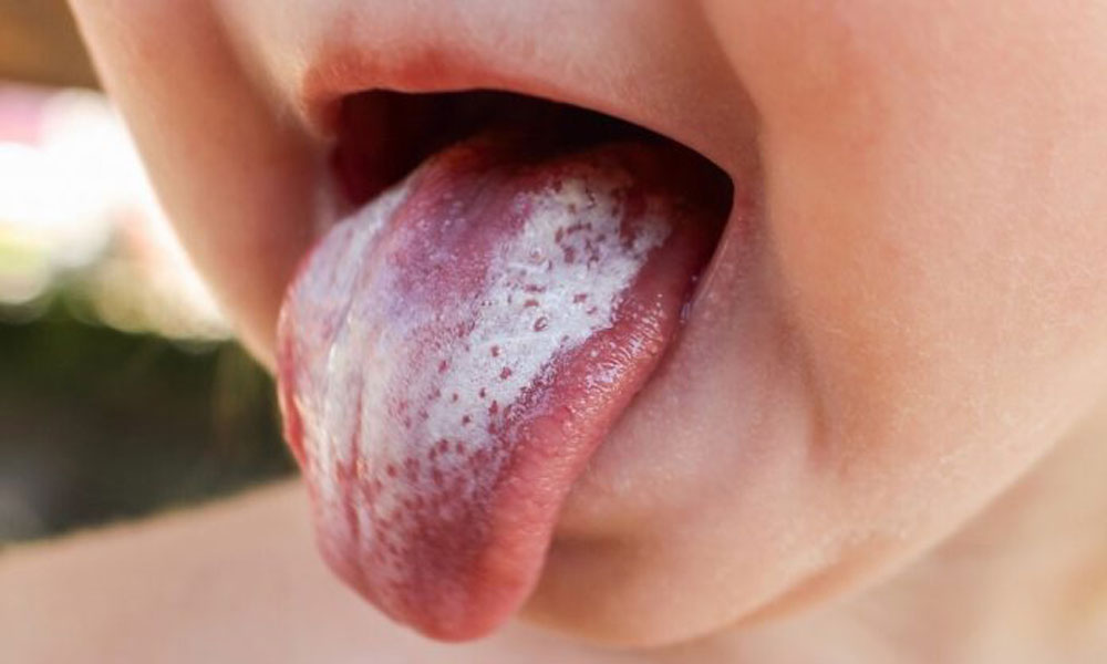 How to Recognize and Treat Oral Thrush?
